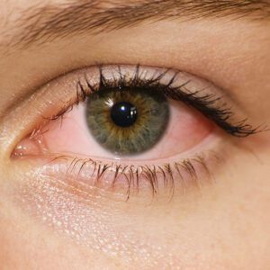 pediatrician pink eye